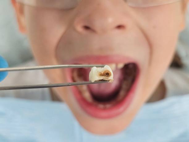 Best Emergency Tooth Extraction  in Imperial, NE